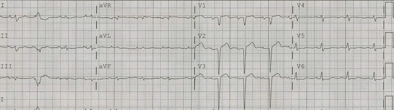 Dr. Smith&#39;s ECG Blog: Left ventricular Aneurysm Morphology Distorted by Right Bundle Branch ...