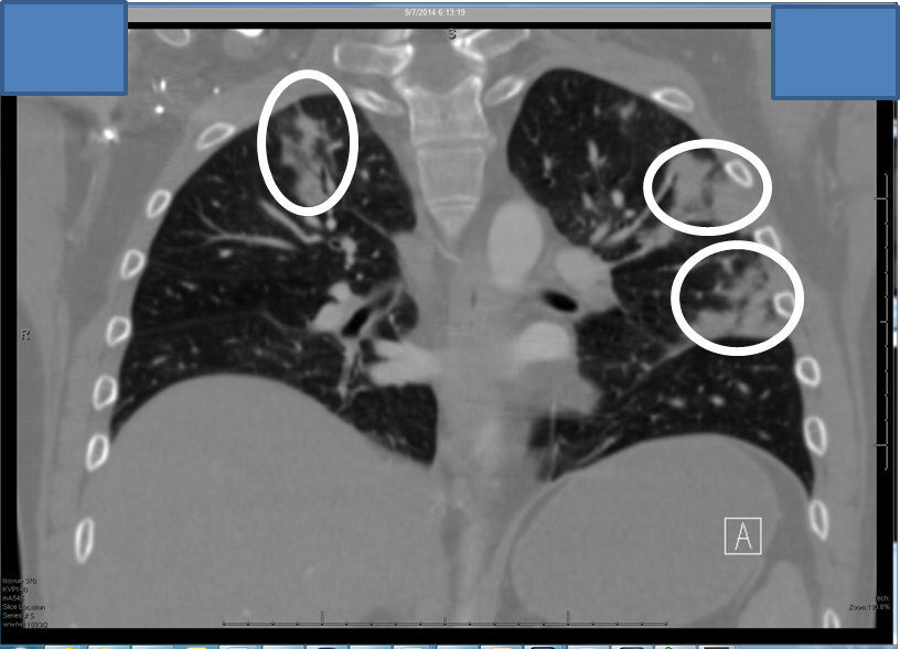 Fungal infection 2021 image