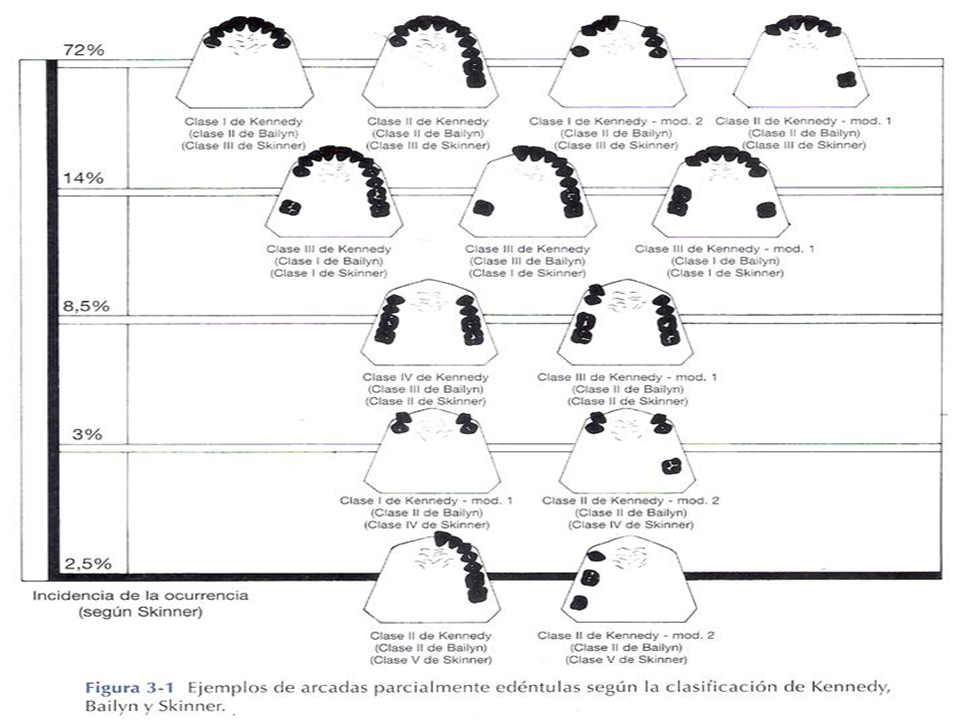 rehabilitaci-n-ii-clasificaci-n-kennedy-1-parte-unidad-ii-y-video