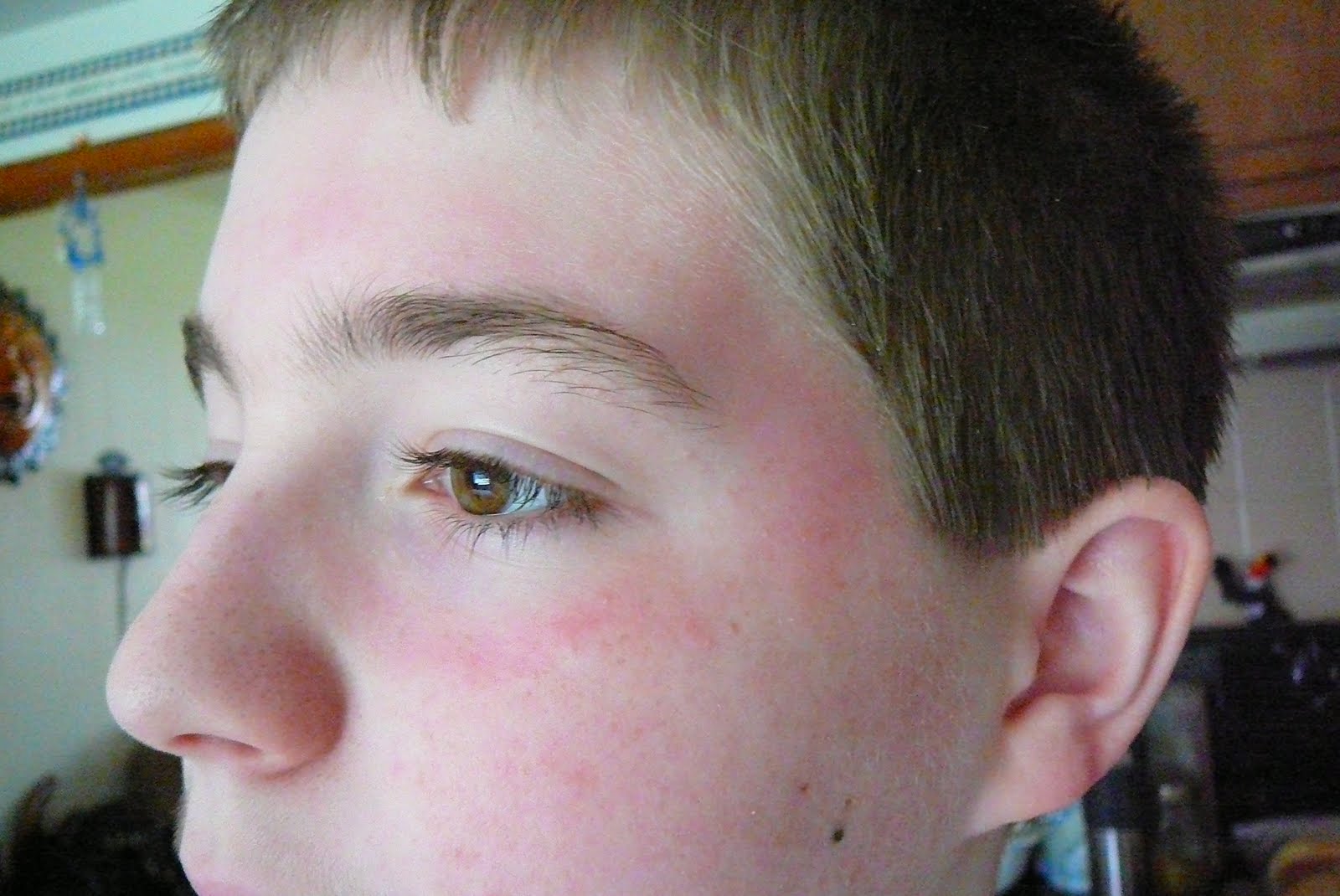 dear-noah-dear-noah-you-have-a-weird-red-ring-rash-sunburn-around