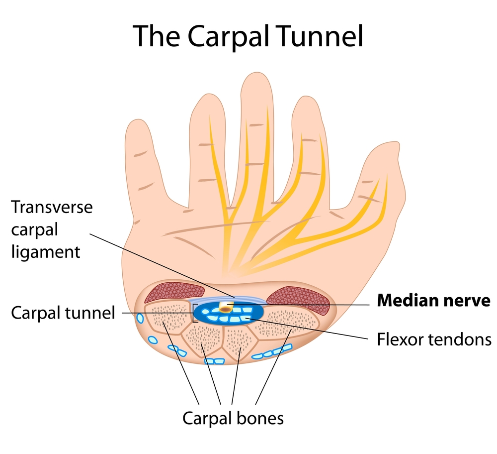 123MyMD Understanding Carpal Tunnel Syndrome