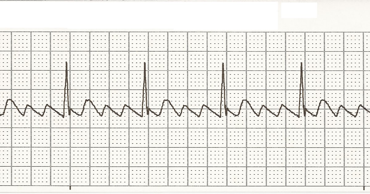 Ekg Atrial Flutter Rhythm Strip Images And Photos Finder