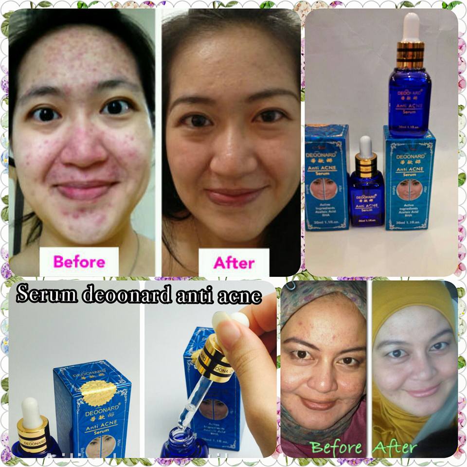 Serum Deoonard Blue Whatsapp 083862459127 Pin Bbm 5ee5b530