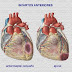 AHIIT y remodelación cardiaca postinfarto