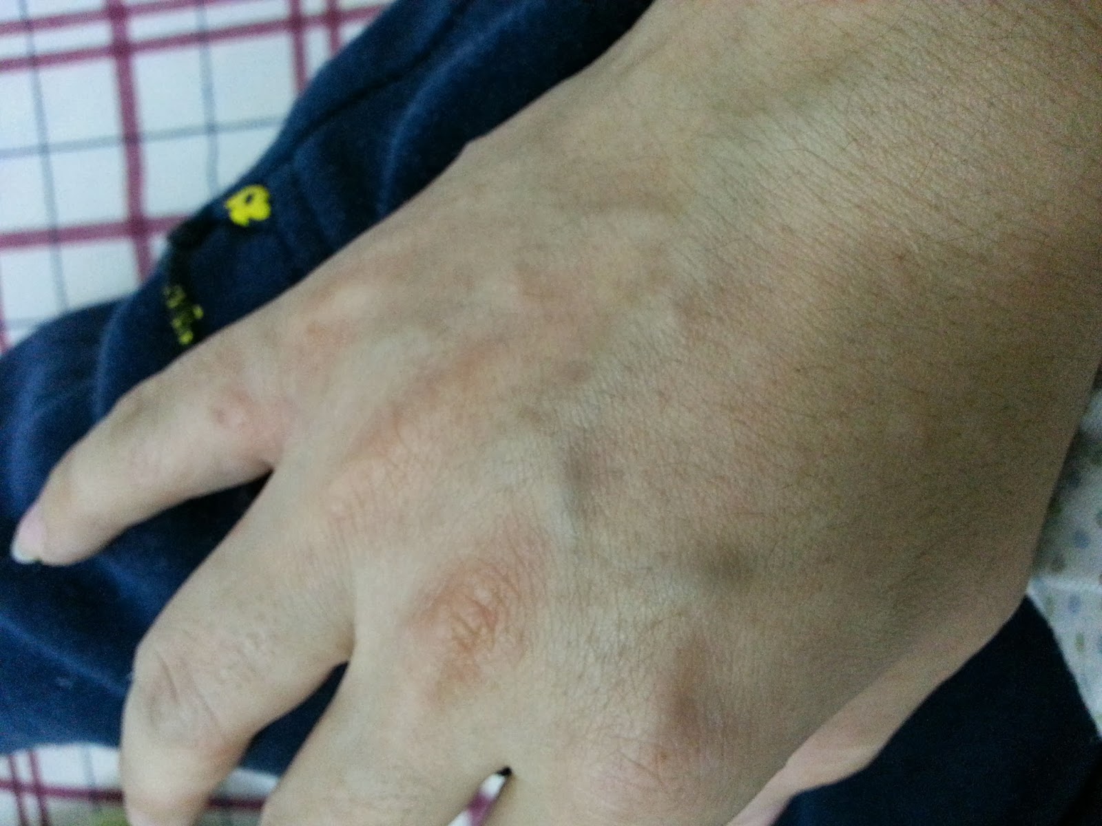 Rose' World Allergy and emotion