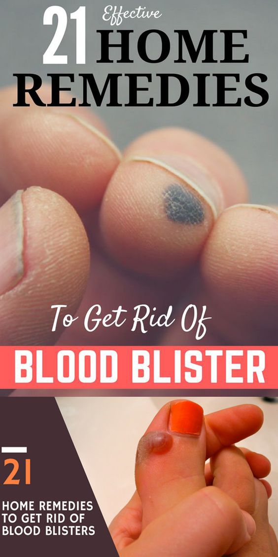 21-wondrous-home-remedies-to-get-rid-of-blood-blisters-beautiful-diy