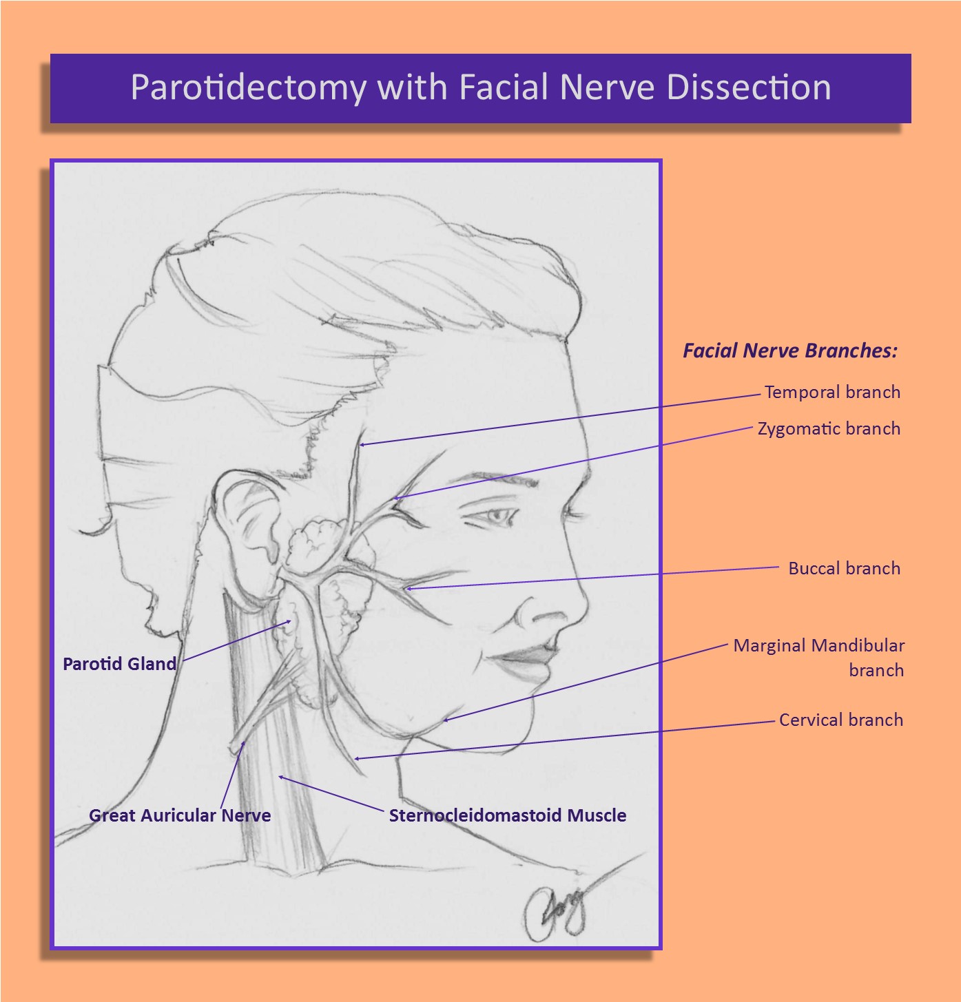Parotid Surgery Parotidectomy and Facial Nerve Dissection