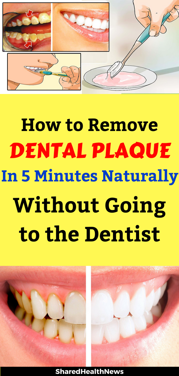 Shared Health News How to Remove Dental Plaque in 5 Minutes Naturally