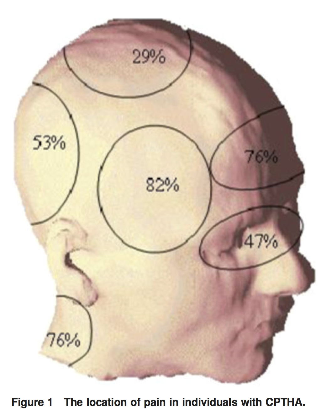 Hospitalist なんでも無い科医の勉強ノート 外傷後頭痛