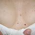 Do You Have These Red Spots On Various Parts Of Your Body? Should You Worry? What Should You Do?