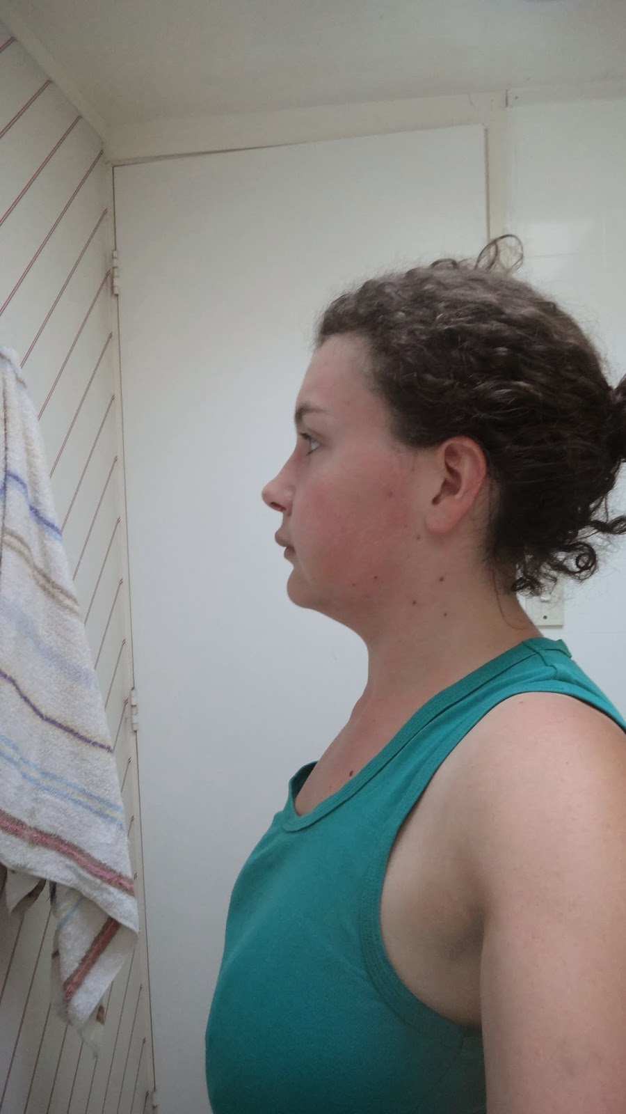 Kelsie's Jaw Surgery: Day 8: The Lopsided Face