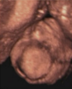 Hafta hafta bebeğin ultrason görüntüleri-18.hafta