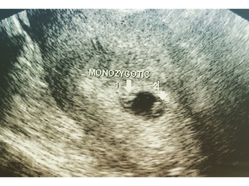 6 Haftalık Gebelik (Hamilelik) Ultrason Görüntüleri Gebelik Görüntüsü