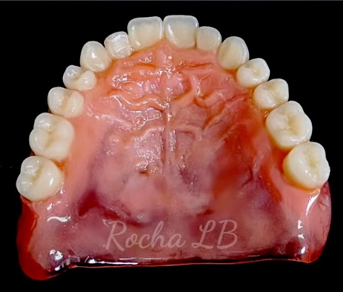 PRÓTESE DENTAL: Rugosidade palatina - Rocha LB