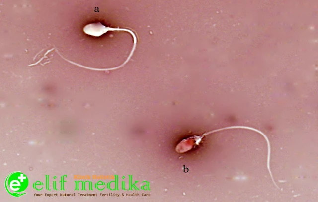 Viabilitas Sperma Menurun (Vitalitas Sperma)