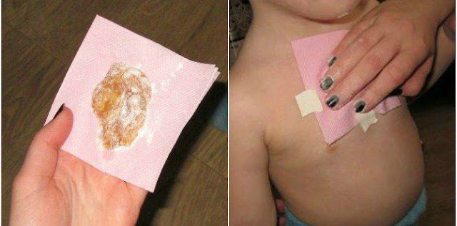 Fenomena Kompres Madu Sebagai Obat Alami Hilangkan Batuk Berdahak Benarkah Efektif? Fenomena Kompres Madu Sebagai Obat Alami Hilangkan Batuk Berdahak Benarkah Efektif?