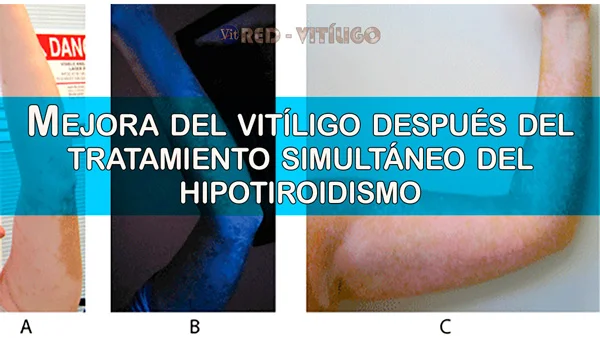 Mejora del Vitiligo después del tratamiento simultáneo del hipotiroidismo.