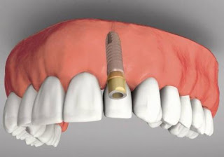 Trồng răng giả có ảnh hưởng gì  không ?