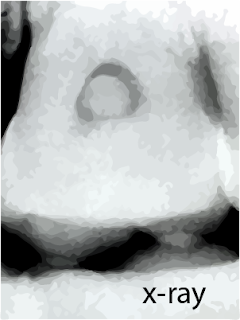 pulp stones