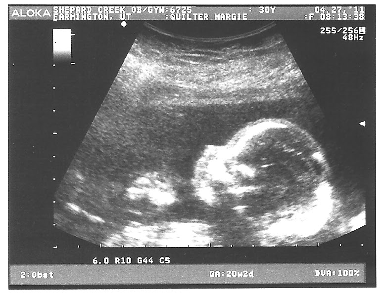 3d ultrasound 20 weeks boy