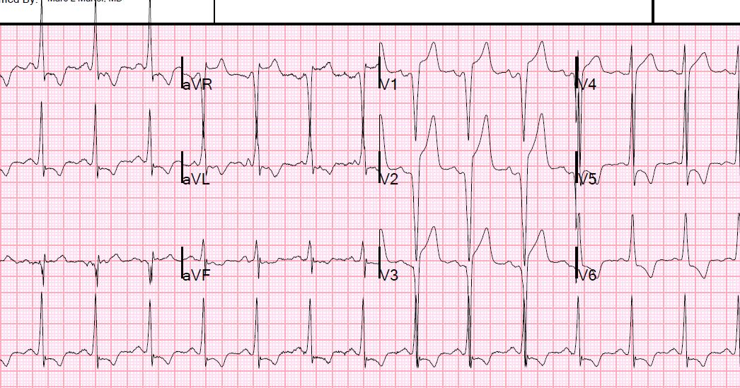 st elevation secondary to ivcd st elevation secondary to ivcd