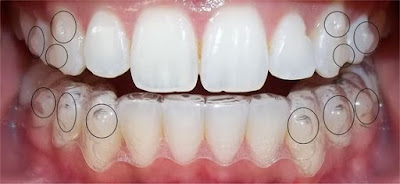 nieng-rang-hieu-qua-voi-Invisalign