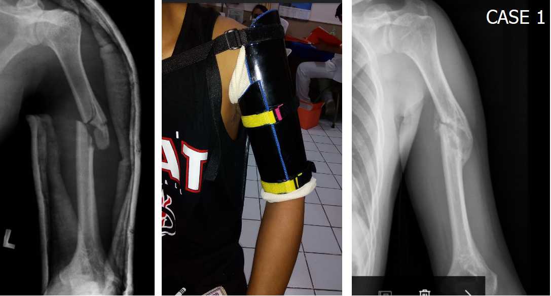 . MAKING HUMERAL FRACTURE BRACES USING PVC PIPES