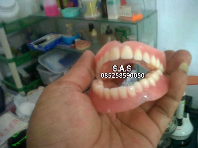 Pasang Gigi Palsu Lengkap Atas Bawah / Ompong Versi Tukang Gigi Jember
