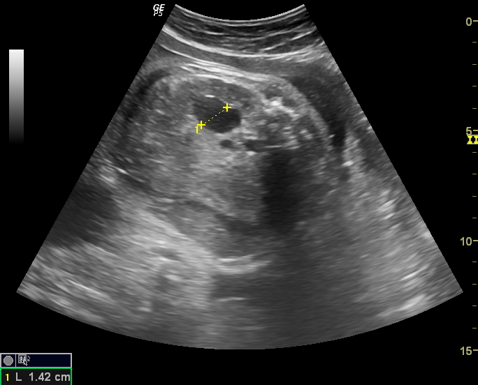 Ultrasound imaging Sonography of a case of bilateral fetal hydronephrosis