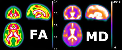 medinria diffusion weighted imaging medinria diffusion weighted imaging