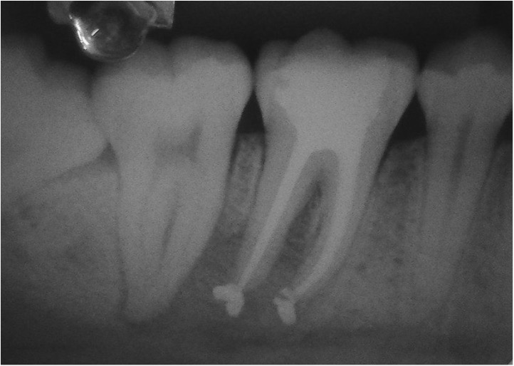 EQUIPE DE ENDODONTIA DE CAMPINAS Caso Clínico da Aluna do Aperf. Noturno em Endodontia da EEC