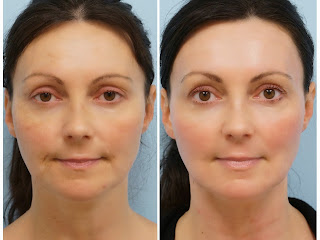 co2 resurfacing fractional before after surgery acne skin facial plastic fine downtime wrinkles scarring low