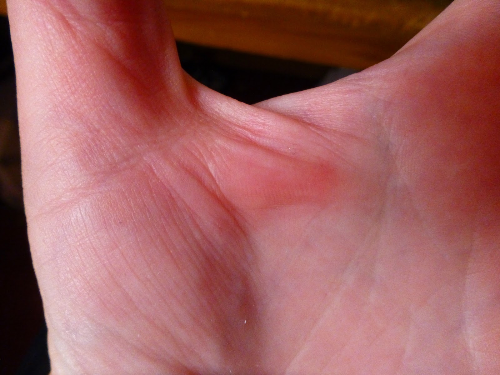 velovoice-sore-hands