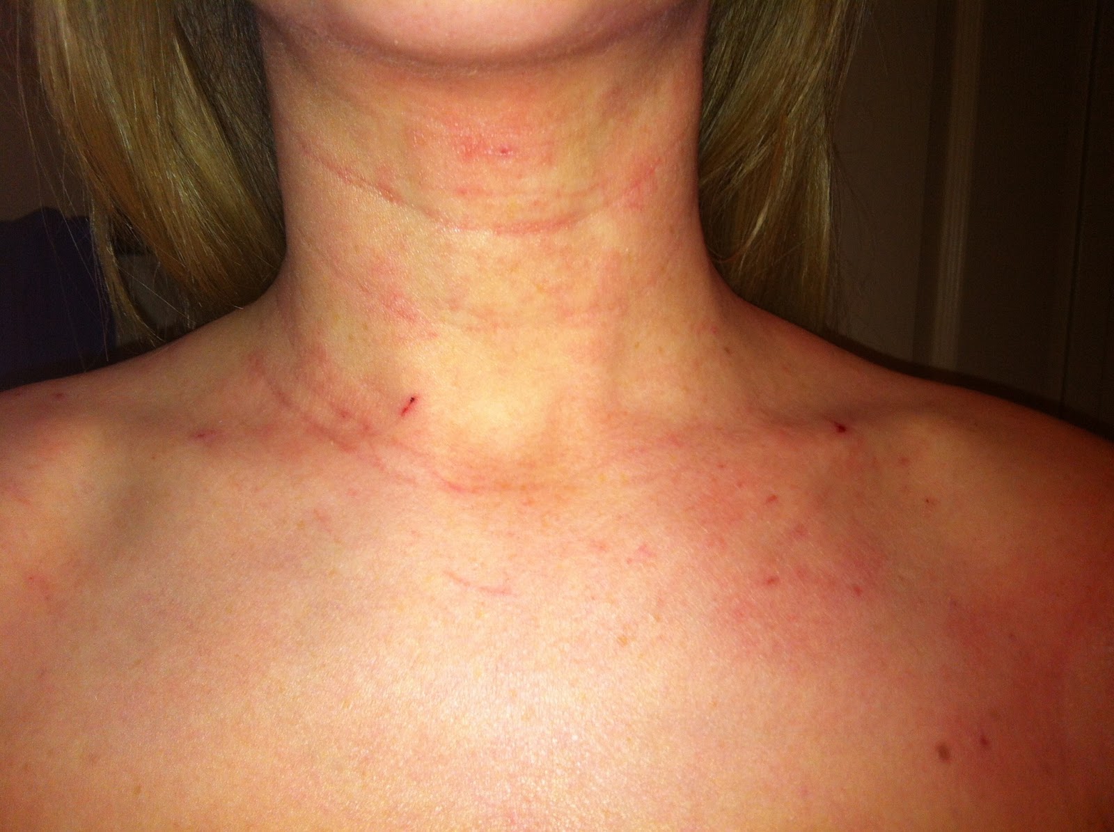 Red Bumps On Neck Pictures Photos