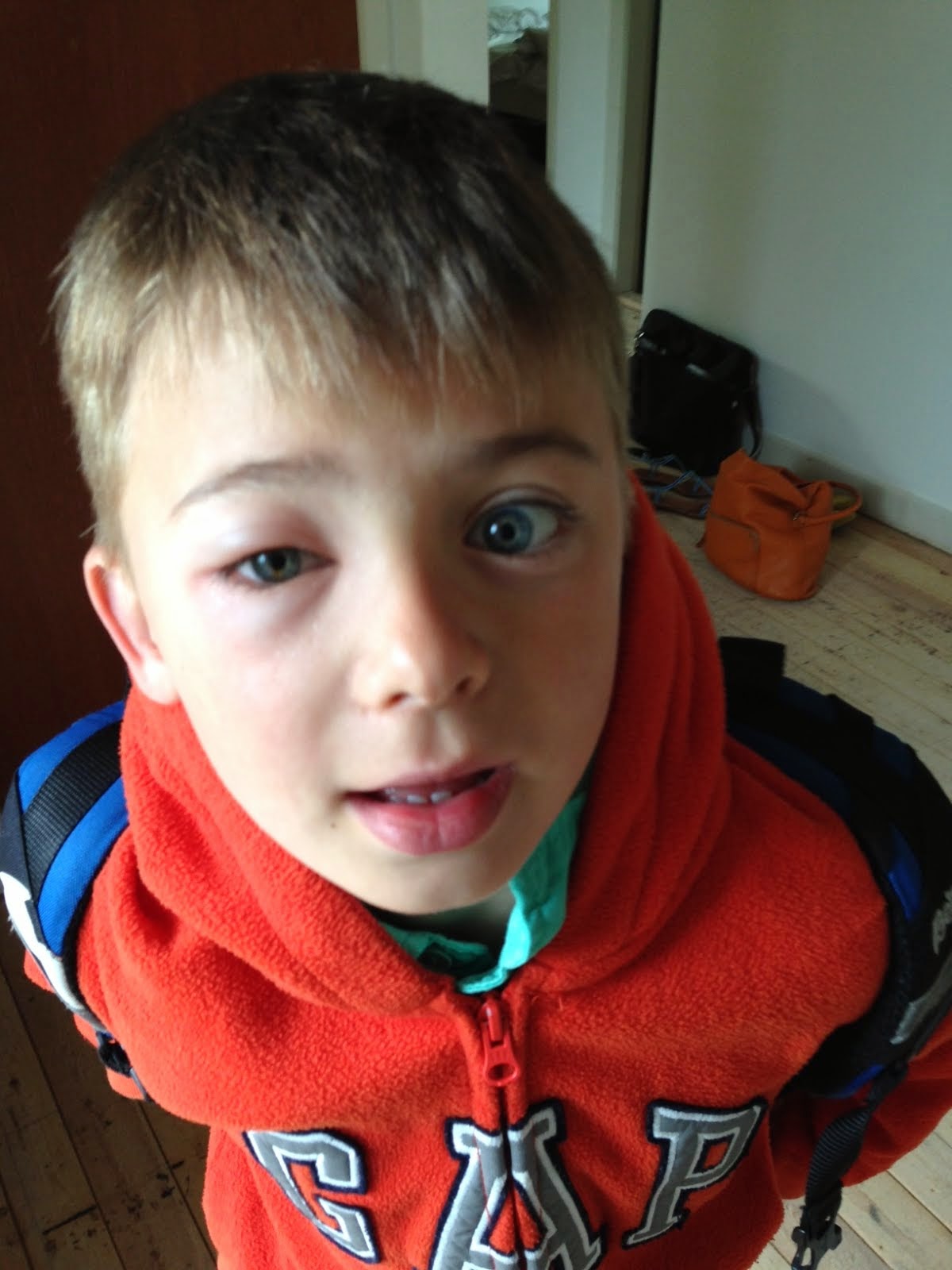 William's little world Insect bite under the eye yesterday.