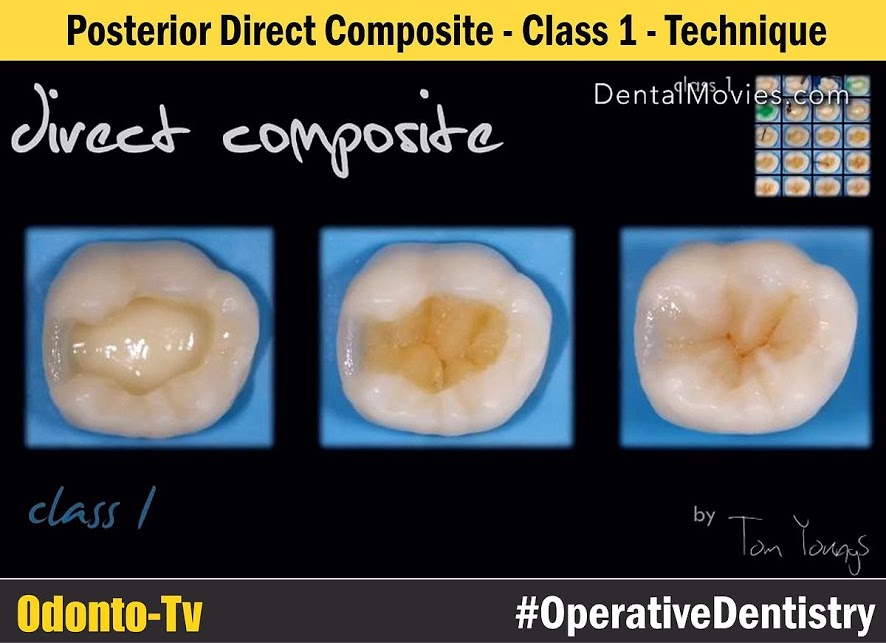 COMPOSITE RESTORATION Posterior Direct Composite Class 1 Technique