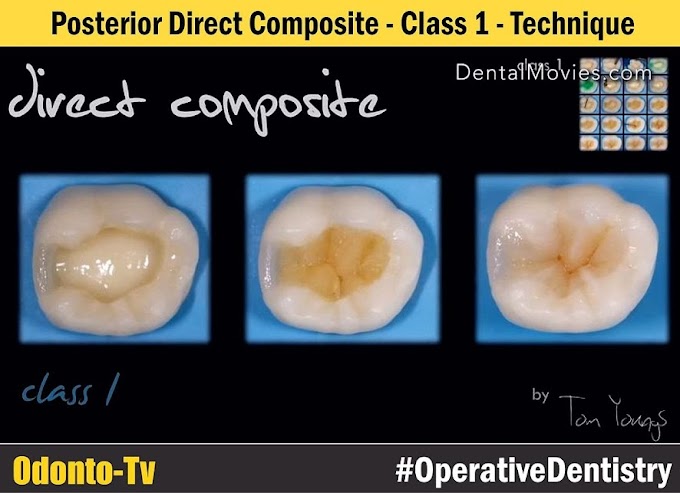 COMPOSITE RESTORATION: Posterior Direct Composite - Class 1 - Technique