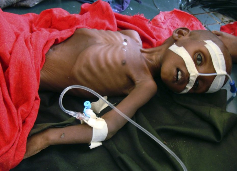 Ahmed Husein, 9 años. Hospital de Banadir, Mogadiscio, Somalia (2011) Foto: Associated Press