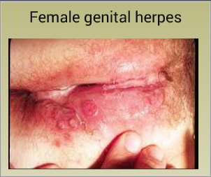 Genital sores - female - Vidant Health