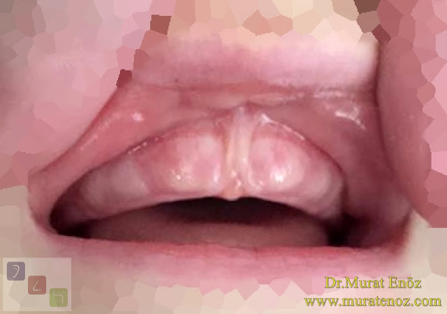 Alveoler hipoplaziye neden olan üst dudak bağı - Üst dudak bağına bağlı üst çene kemiğinde yapısal etkilenme - Üst dudak bağının zararları - Dudak bağının zararları