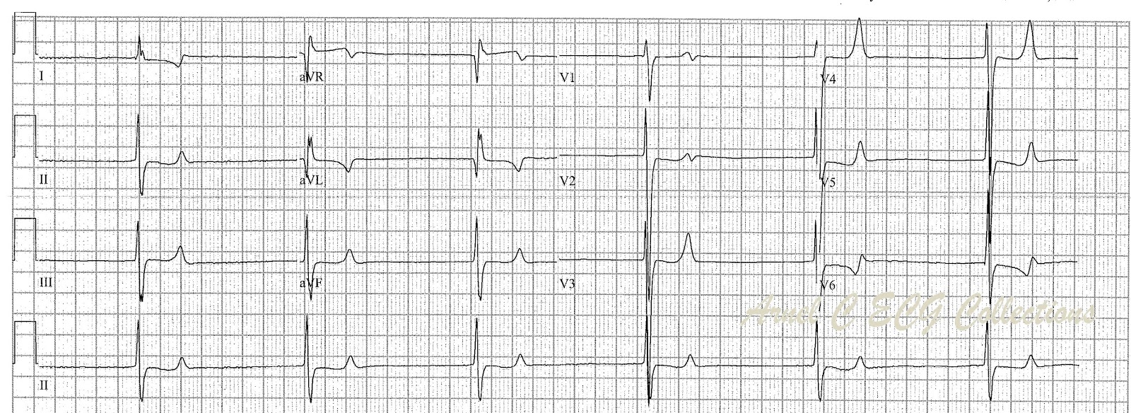 ECG Rhythms Junctional Rhythm with Hyperkalemia