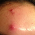 What Exactly is Happening When You Forcefully Pop Out A Pimple