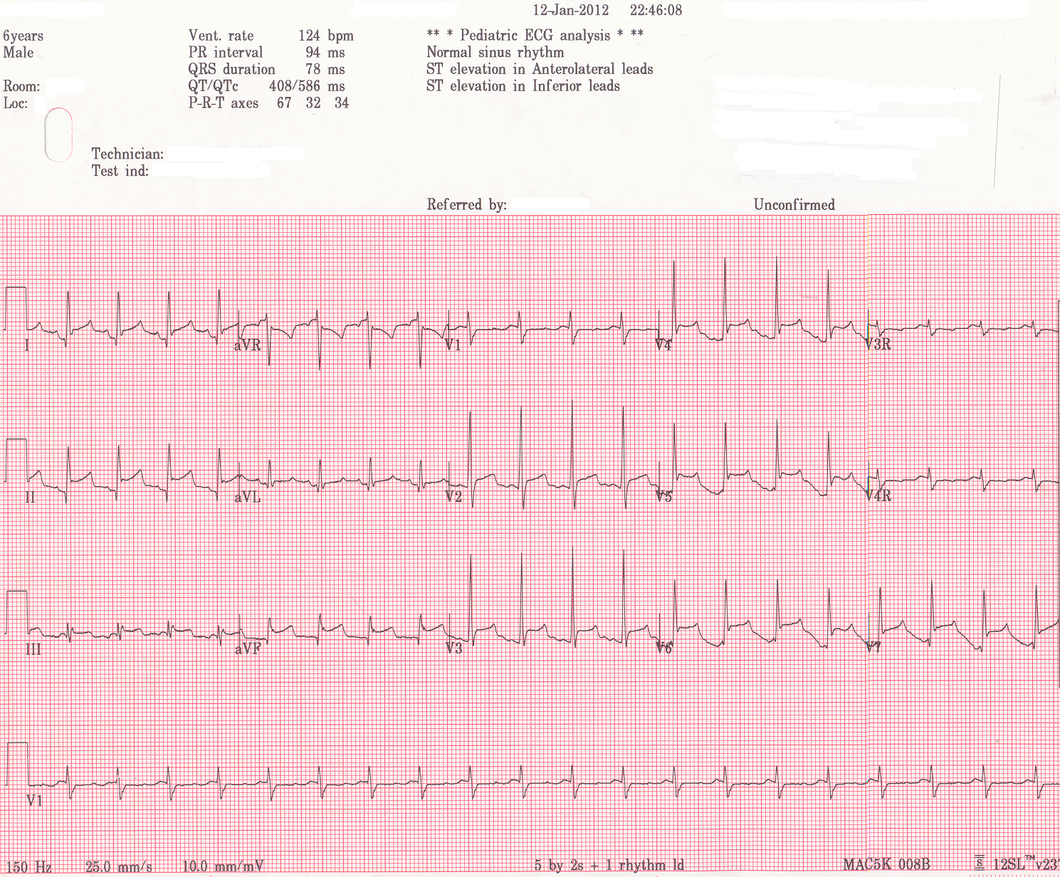 Pedi cardiology: EKG: Postop. pericarditis