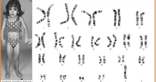 Perhatikan ciriciri akibat mutasi kromosom berikut! (1