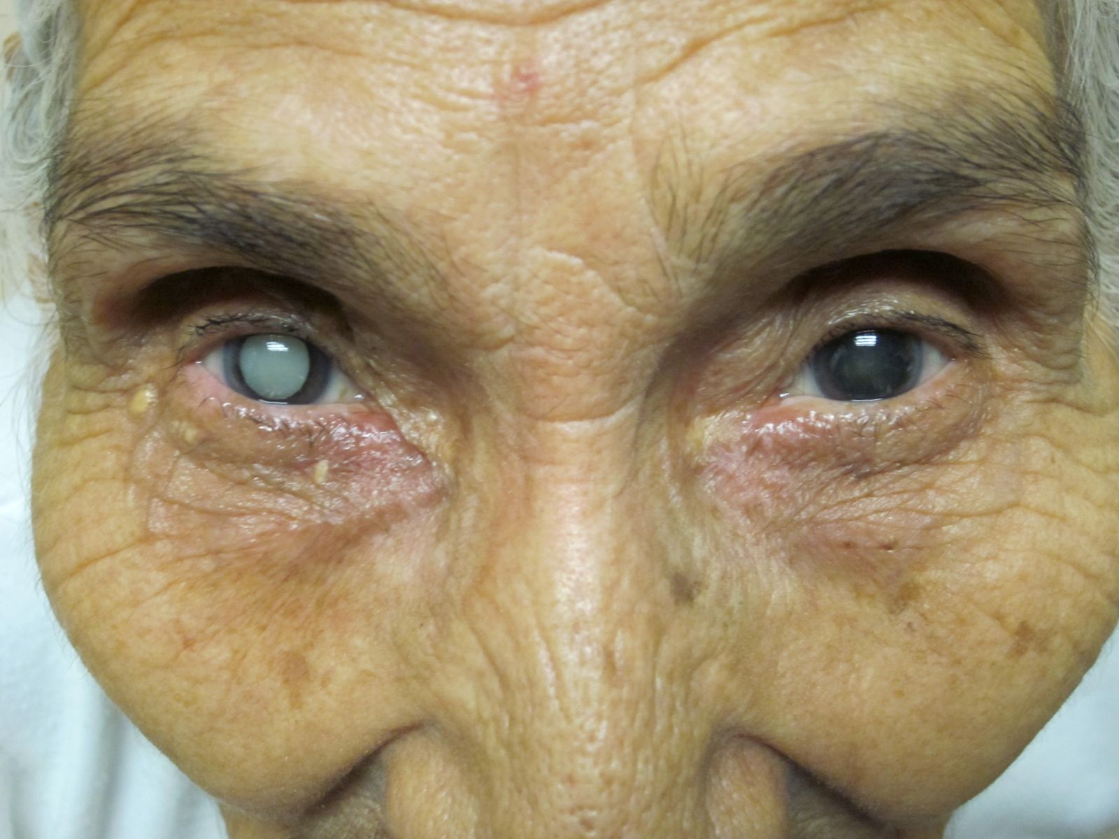 Before and After Cataract OperationsBefore and AfterBefore and After