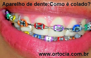 aparelhos nos dentes colorido