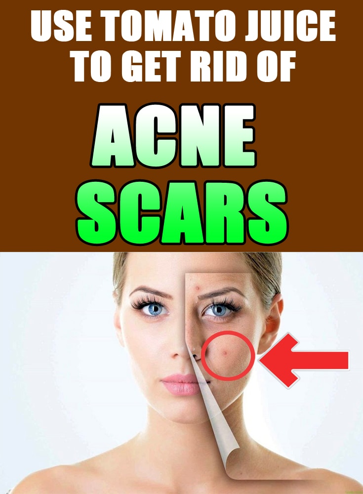 How To Get Rid Of Acne Scars Home Remedies 3 Best Ways Natural remedies