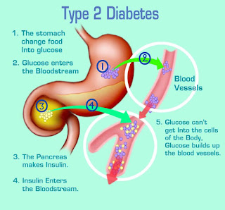 Komplikasi Diabetes Tipe 2