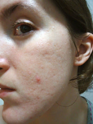 beautypul, adapalene, adapaleno, mi experiencia, retinal, retinol, retinyl palmitate, tretinoin, tretinoina, vitamina A, 