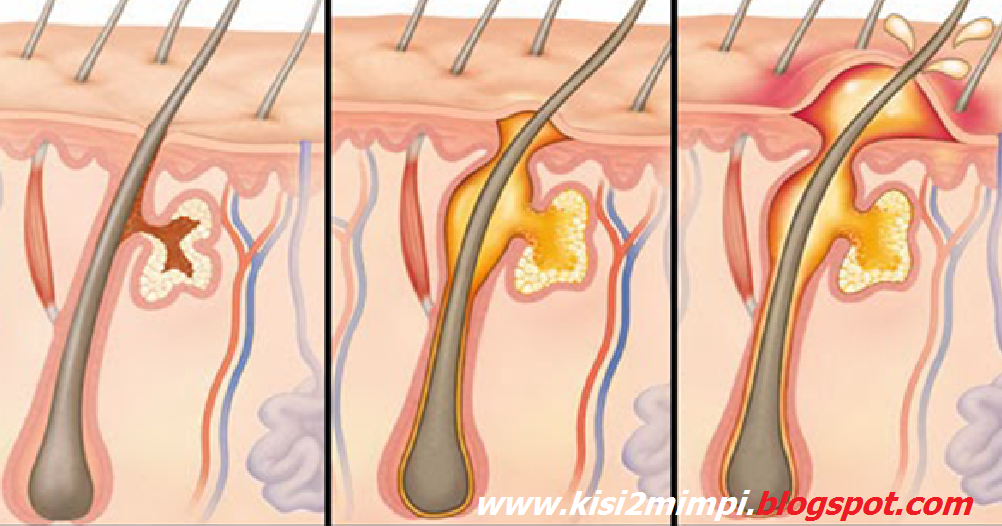 MIMPI BISUL (Menurut Primbon Jawa)